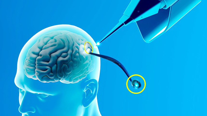 За първи път е имплантиран мозъчен чип на човек